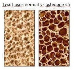 Tesut osos normal si tesut osos cu osteoporoza